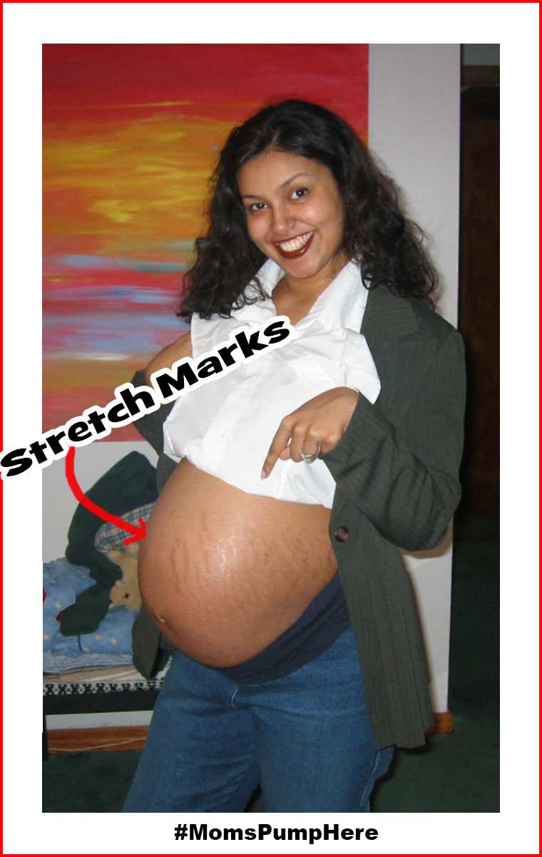 Pregnancy stretch marks