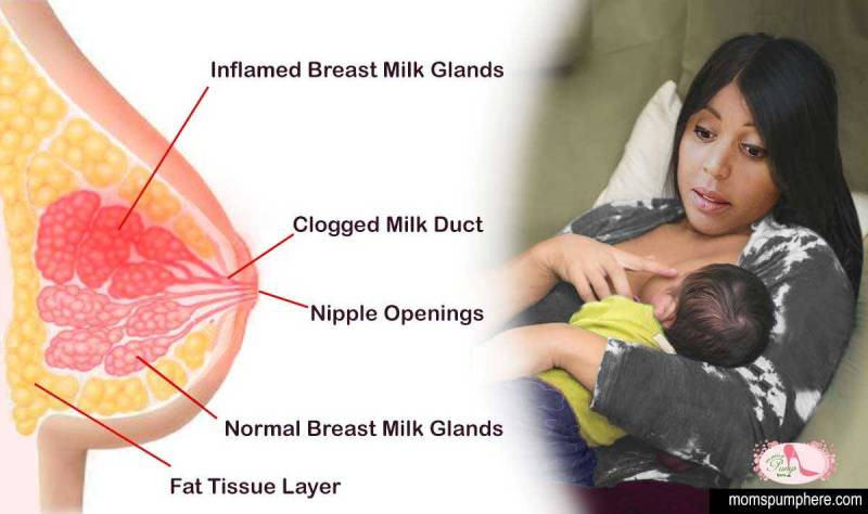 Mastitis While Breastfeeding Causes and Treatments