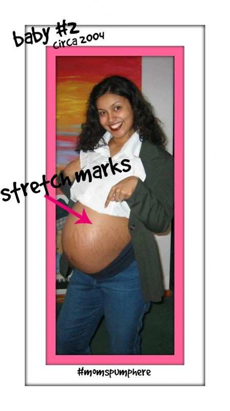 Pregnancy Stretch Marks - My Forever Scars